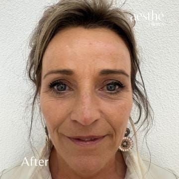 before-frons-after-detail (1)