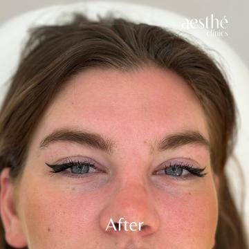 botox-voorhoofd-after-detail (1)