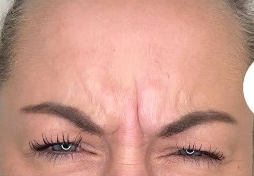 botox_fronsrimpel_foto_ivy_clinics-detail