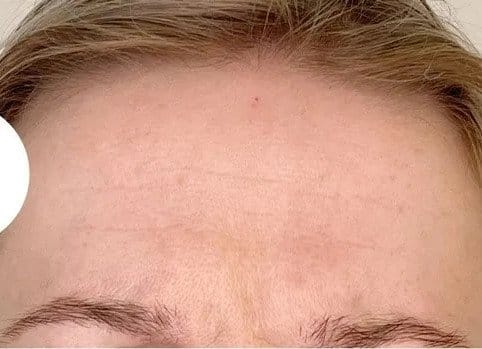 botox_rimpels_ivy_clinics-detail (1)