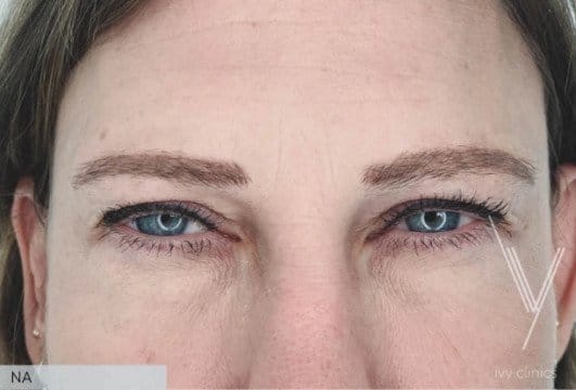 botox_voorhoofd_ivy_clinics-detail (1)