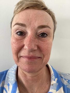 frown-lines-after-botox-detail