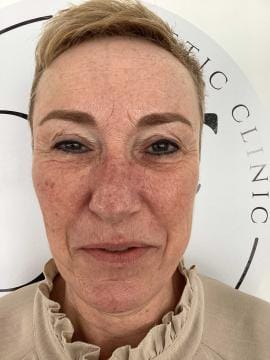 frown-lines-before-botox-detail