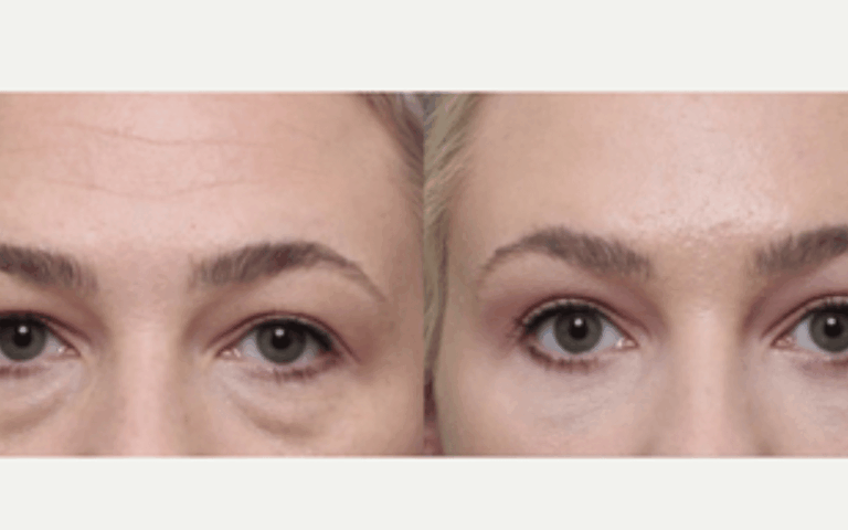 Wallen of ‘vochtzakjes’? Waarom alleen slapen niet helpt en een onderooglidcorrectie vaak de enige oplossing is