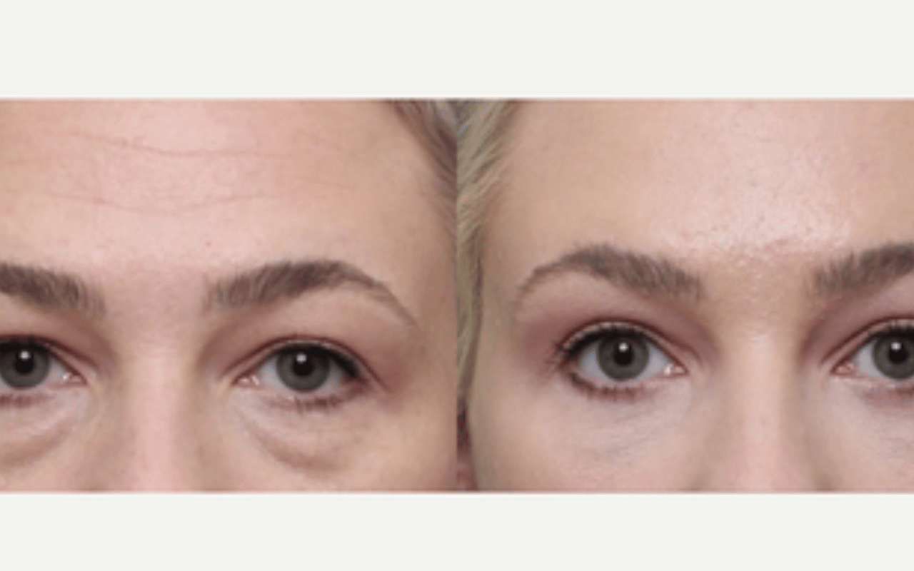 Wallen of ‘vochtzakjes’? Waarom alleen slapen niet helpt en een onderooglidcorrectie vaak de enige oplossing is