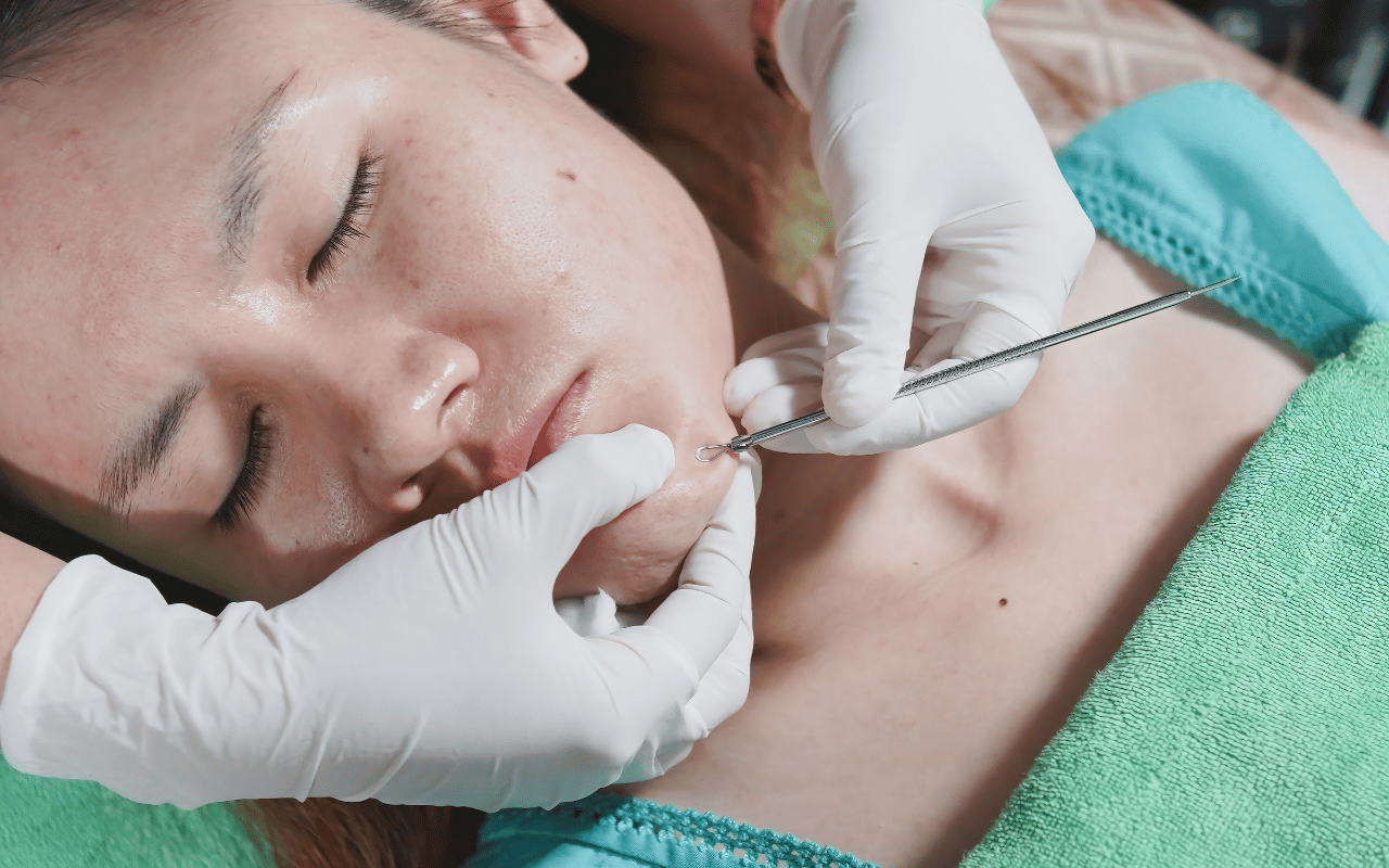 Van grove poriën tot acne-littekens: met deze 3 methodes krijg je weer een egale huid