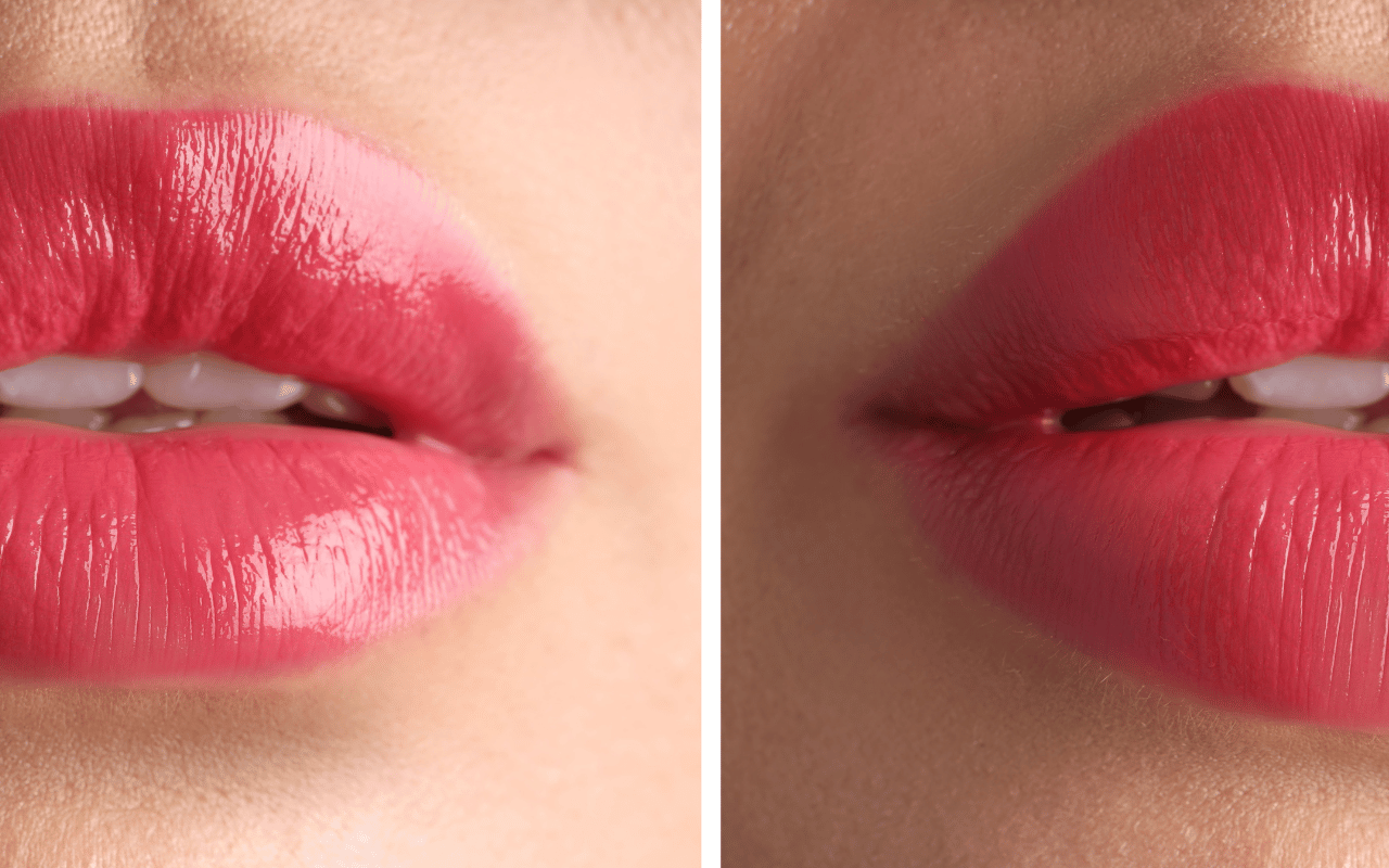 Lipfillers: hoeveel ml is echt nodig en wat is het verschil met een ‘lip flip’?
